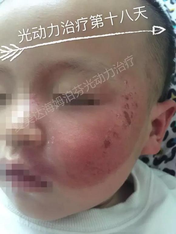 鲜红斑痣最新疗法突破传统，重塑肌肤美丽新篇章