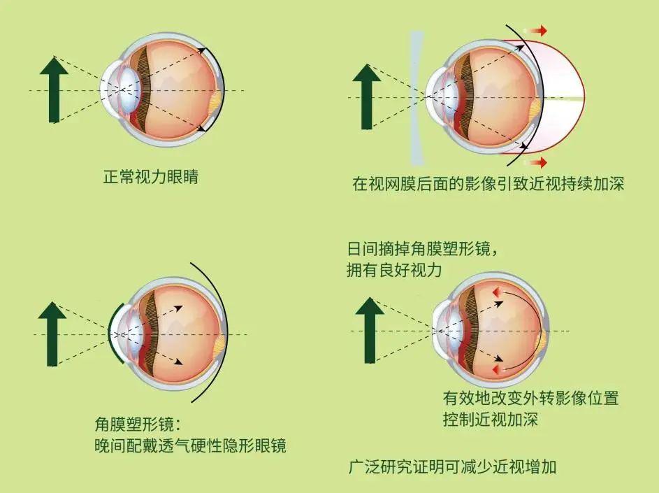 治疗近视最新技术揭秘，最新科技手段助你恢复视力