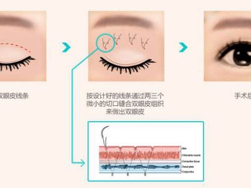 韩国最新埋线技术解析与应用探讨