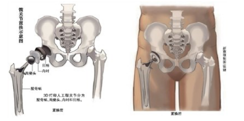 揭秘人工髋关节价格全解析！一篇文章让你洞悉价格真相！